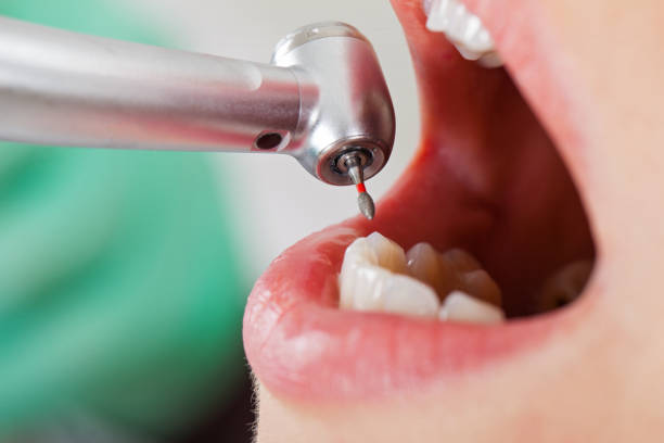 Best Emergency Wisdom Tooth Extraction in Johnston, SC